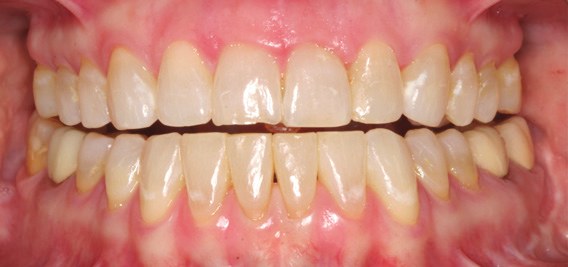 Teeth closed together in the everyday bite, no appliance in place