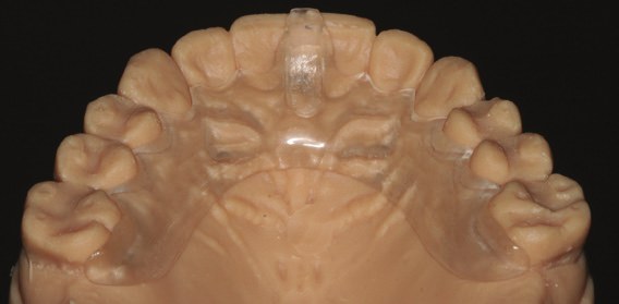 The Kois Deprogrammer on a plaster model of the upper teeth