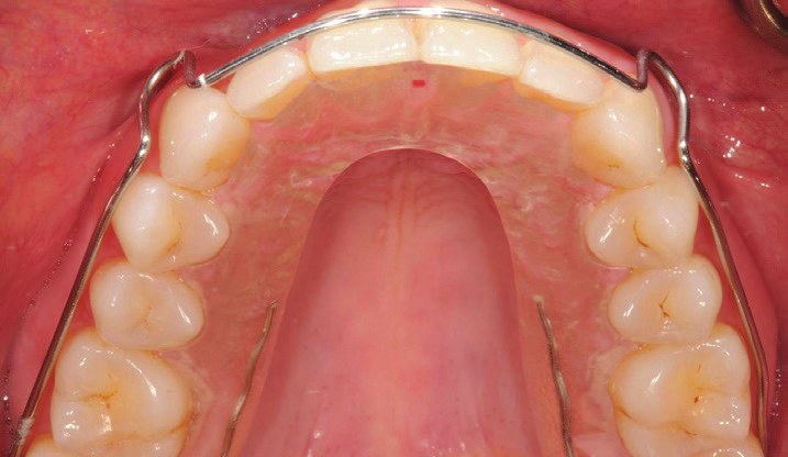 The Kois Deprogrammer seen from below, showing the platform behind the upper front teeth
