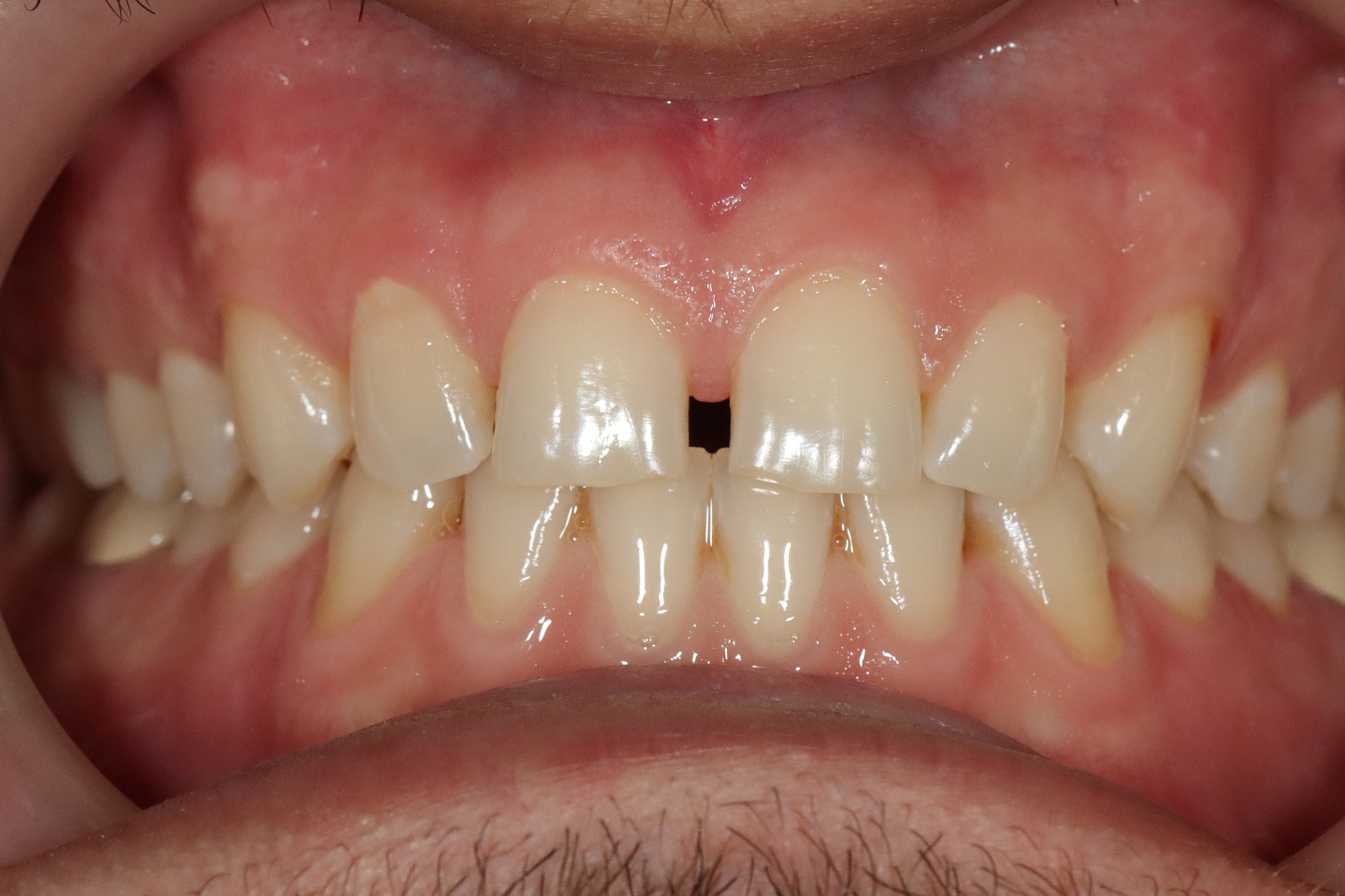 After image