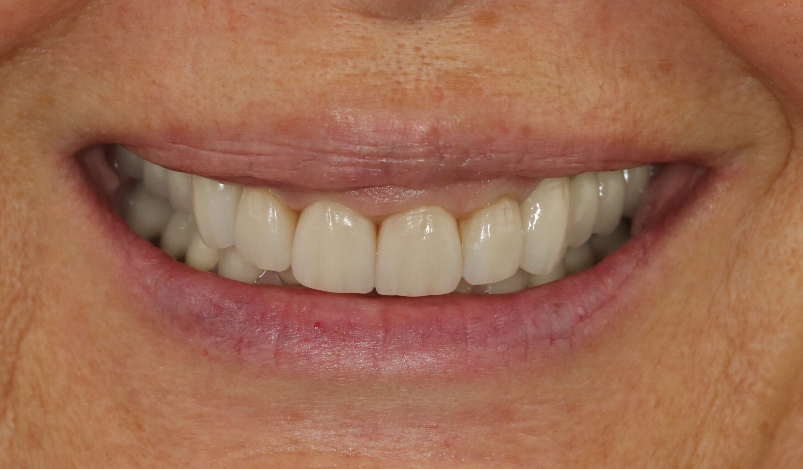After image